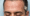 Is Hair Transplant Painful