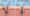 Is TRT Hair Loss Reversible