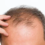 Does Surgery Cause Hair Loss