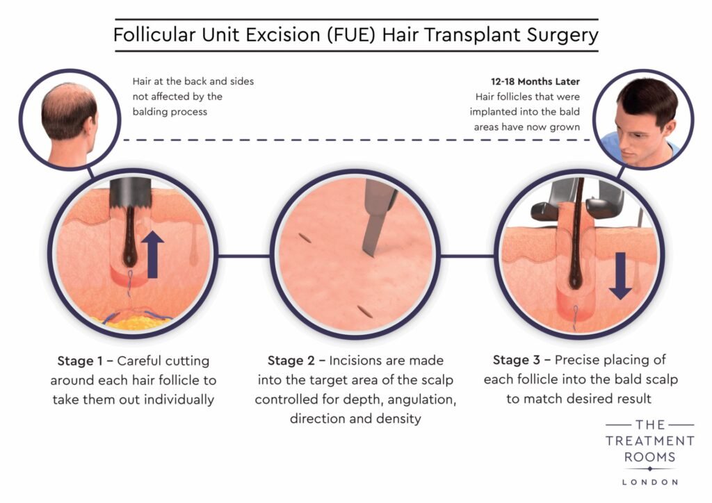 MCAN Hair Graft Calculator
