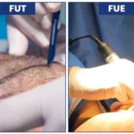 Hair Transplant at Age 60