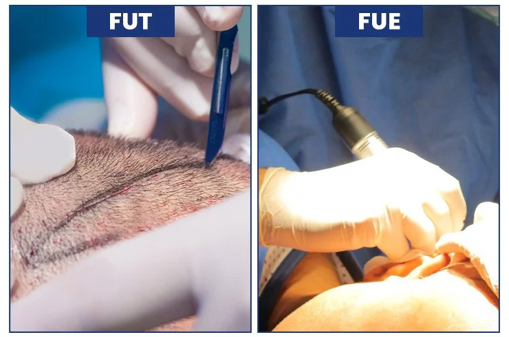 Hair Transplant at Age 60