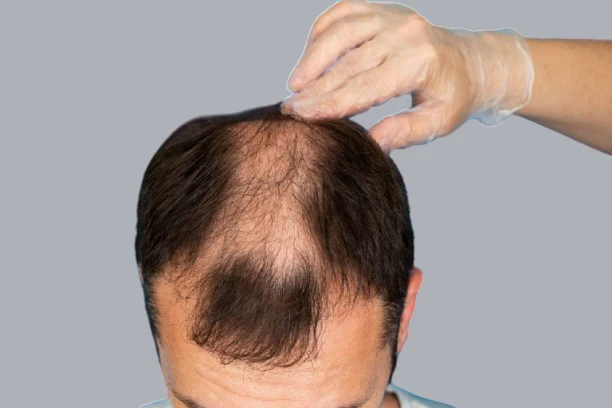 Hair Loss Treatment in Houston