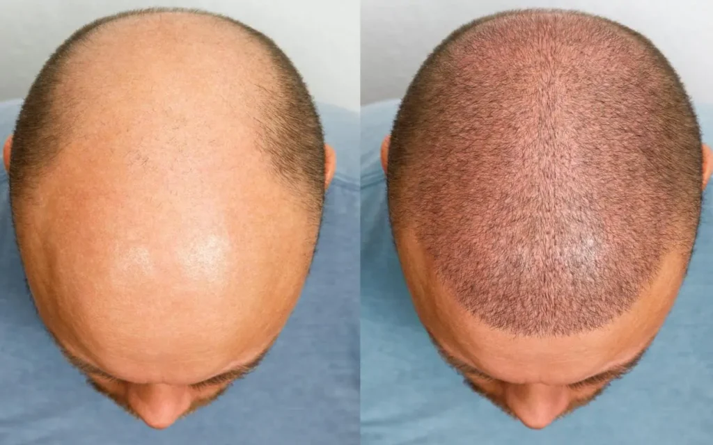 Hair Transplant at Age 60