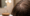 Can Sunburn on Scalp Cause Hair Loss
