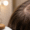 Can Sunburn on Scalp Cause Hair Loss