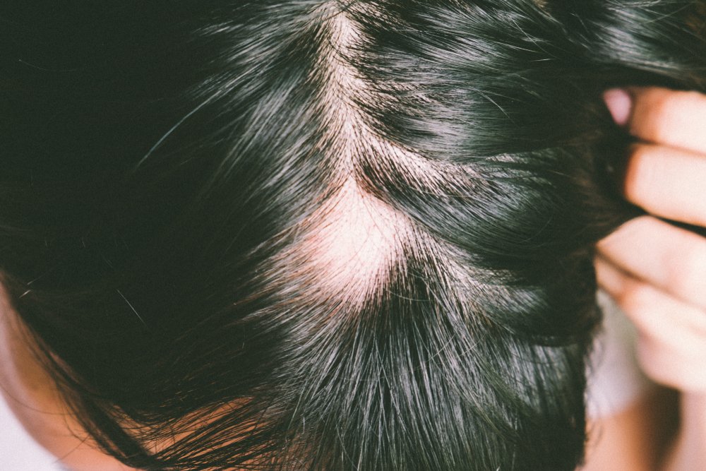 Hair Loss Experts Near Me