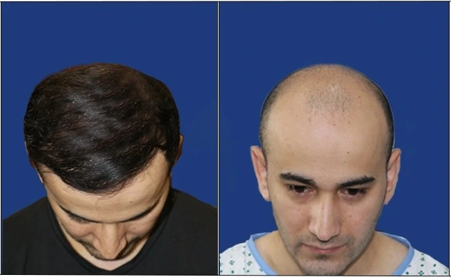 Hair Loss Treatment in Houston