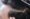 Can Herpes Cause Hair Loss