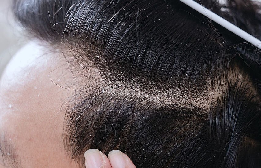 Can Herpes Cause Hair Loss