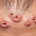 Folliculitis and Hair Loss