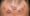 Folliculitis and Hair Loss