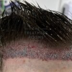 Good Hair Transplant