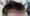 Hair Transplant Process