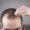 Chlorine and Hair Loss