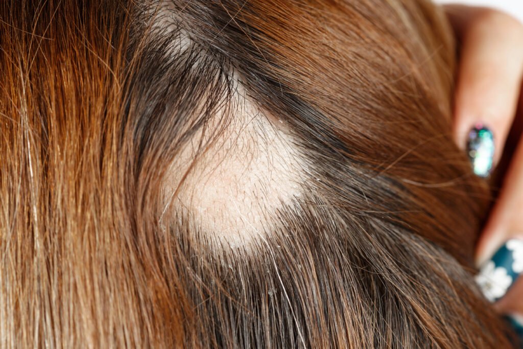 What Is Scarring Alopecia?
