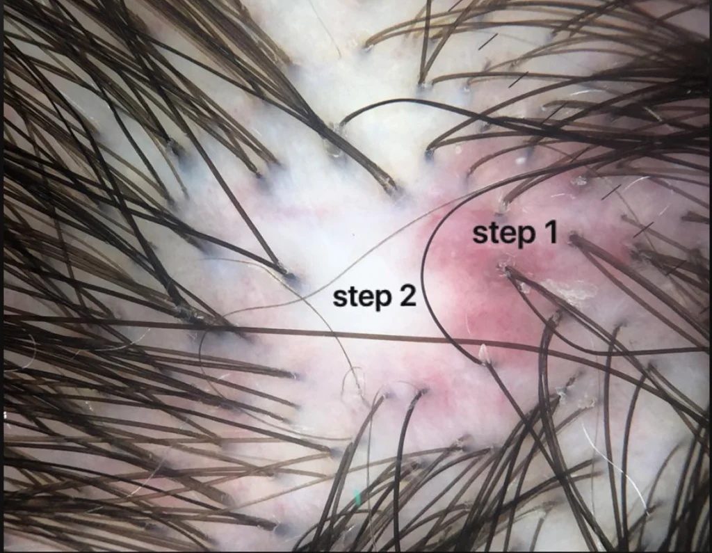 What Is Scarring Alopecia?