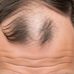 Edging Hair Loss