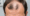 Edging Hair Loss