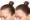Female Hair Transplant in Islamabad