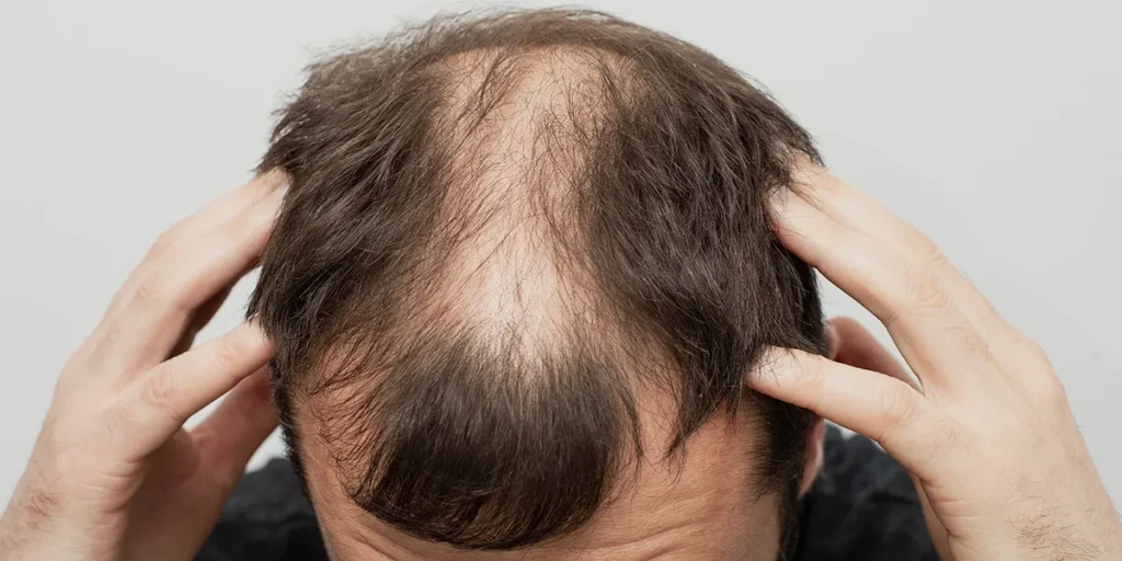 Hair Loss and Depo Provera