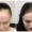 Hair Transplant Cost for Females in Pakistan
