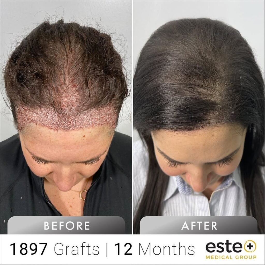 Hair Transplant Cost for Females in Pakistan