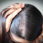 Hair Loss and Depo Provera