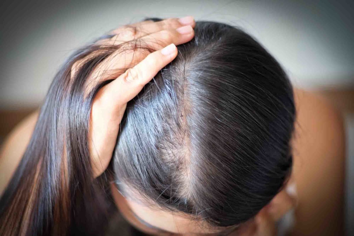 Hair Loss and Depo Provera