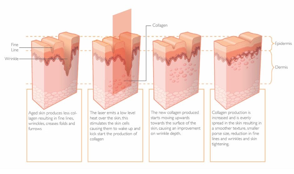 Infrared for Skin
