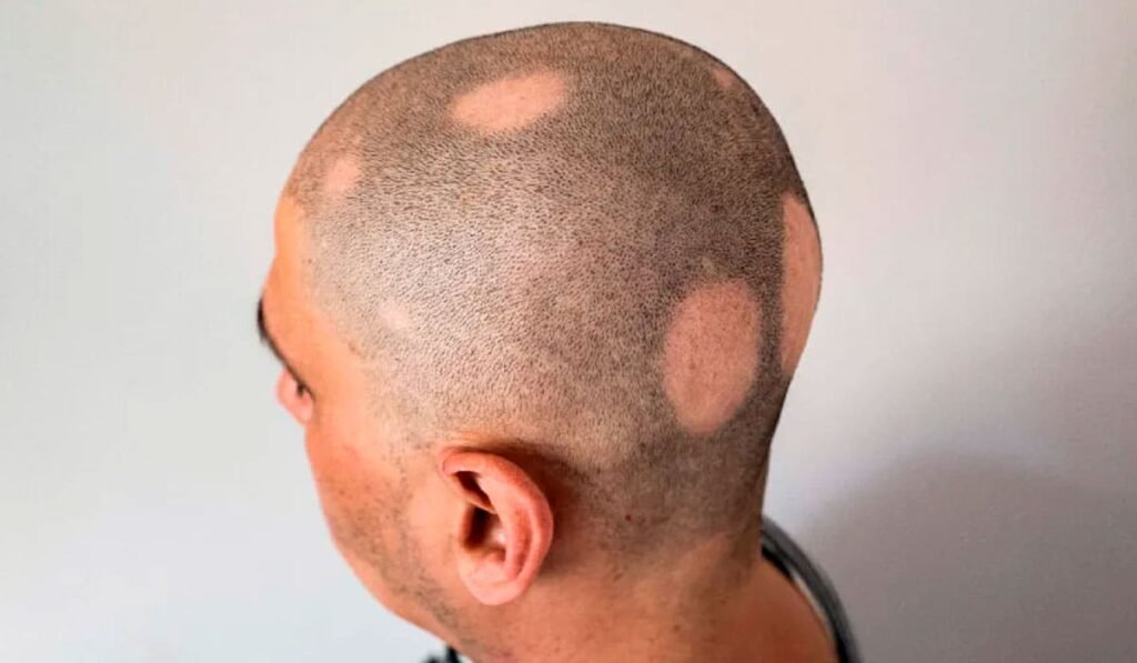 Is Alopecia an Autoimmune Disease