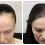 Female Hair Transplant Success Rate