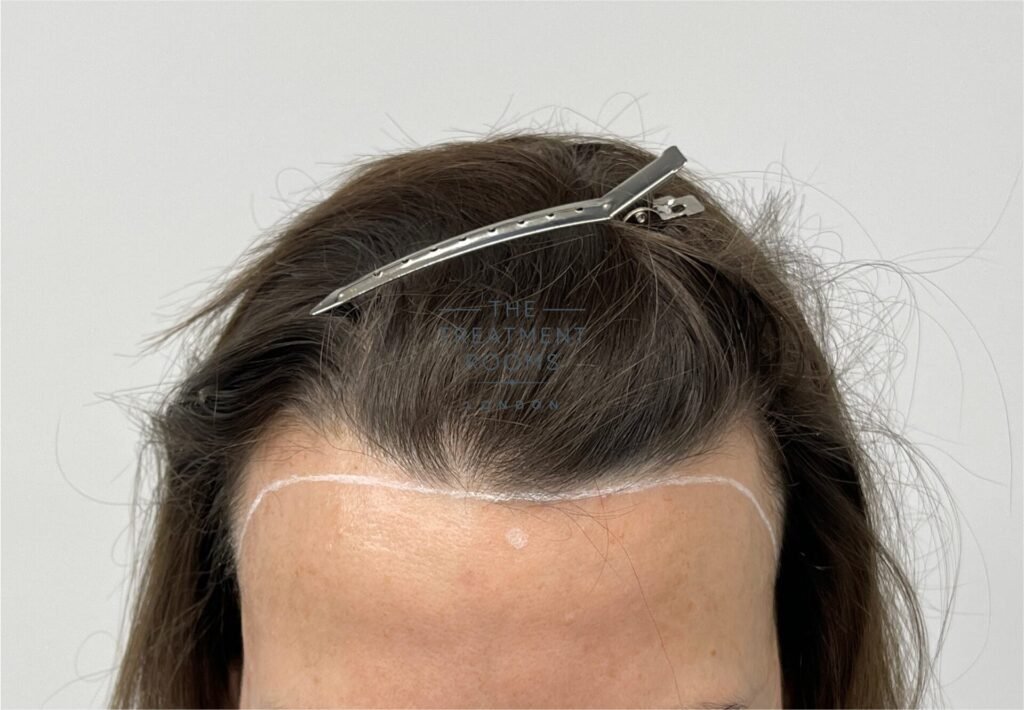 Hair Transplant for Hairline Females