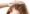 Hair Transplant for Female Pattern Baldness