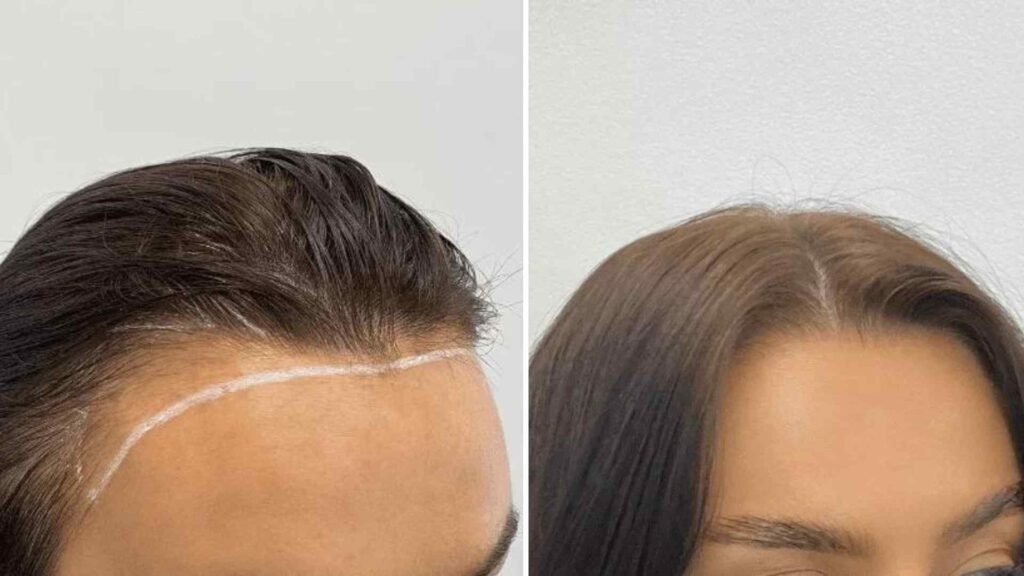 Female Hair Transplant in Islamabad