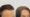 Female Hair Transplant in Islamabad