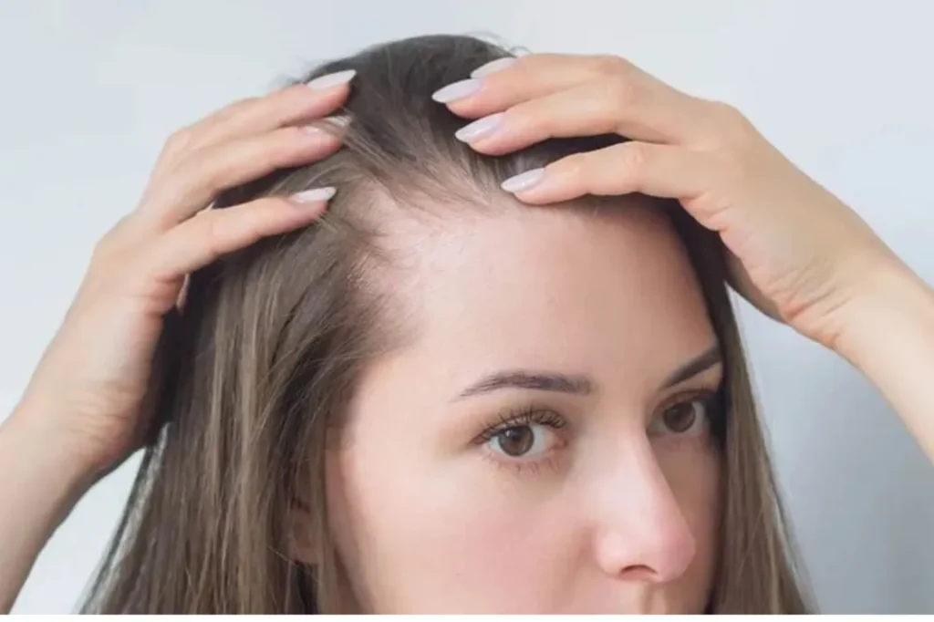 Stage 2 Hair Fall