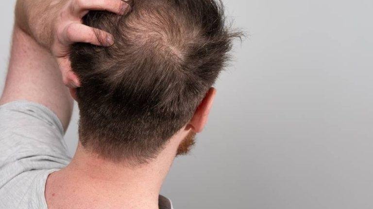 Stage 2 Hair Fall
