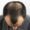 Stage 2 Hair Fall