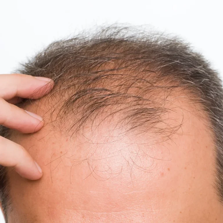Does Surgery Cause Hair Loss