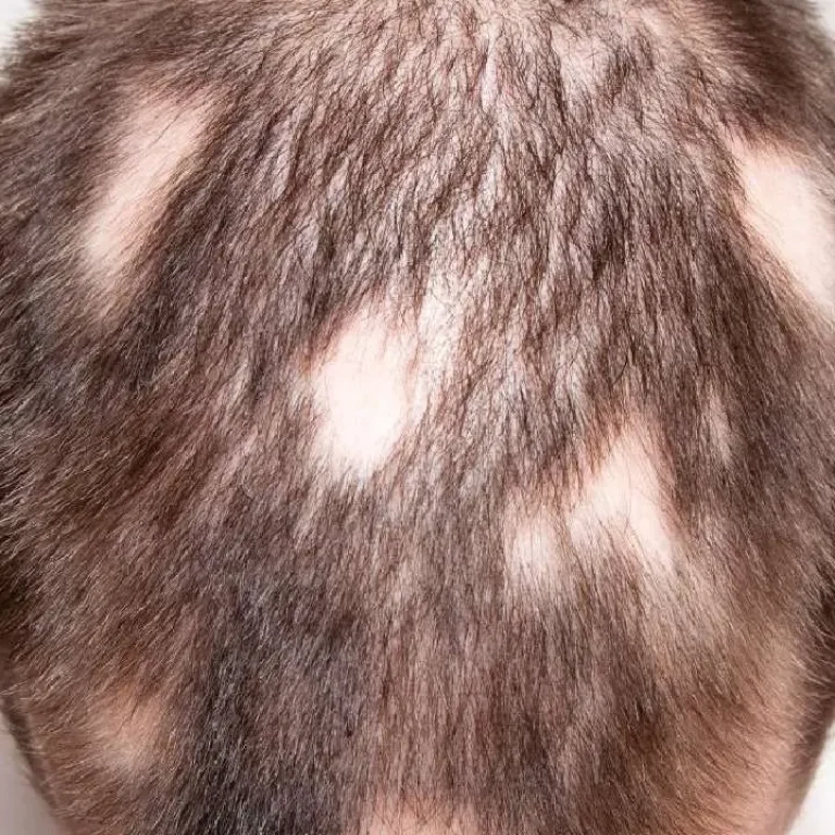 can alopecia areata be reversed