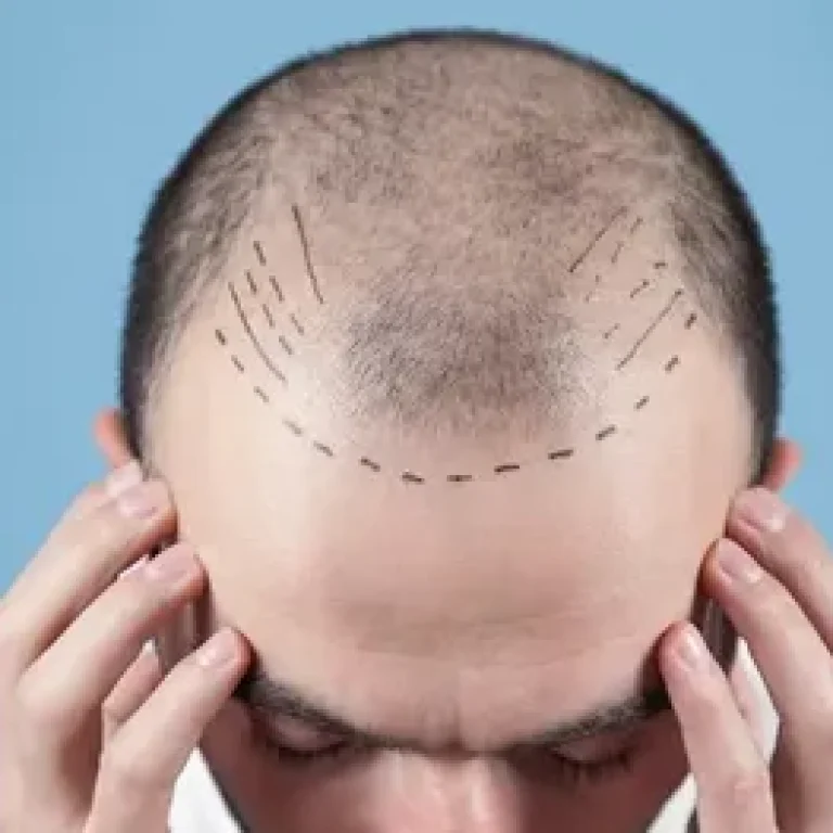 Can I Regrow My Receding Hairline