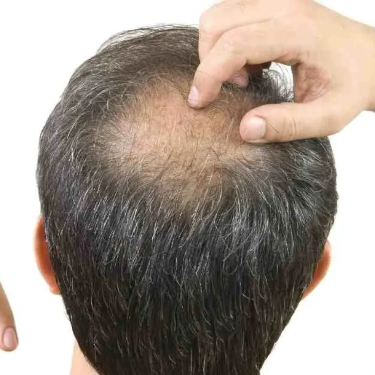 Can a man really grow his hair back