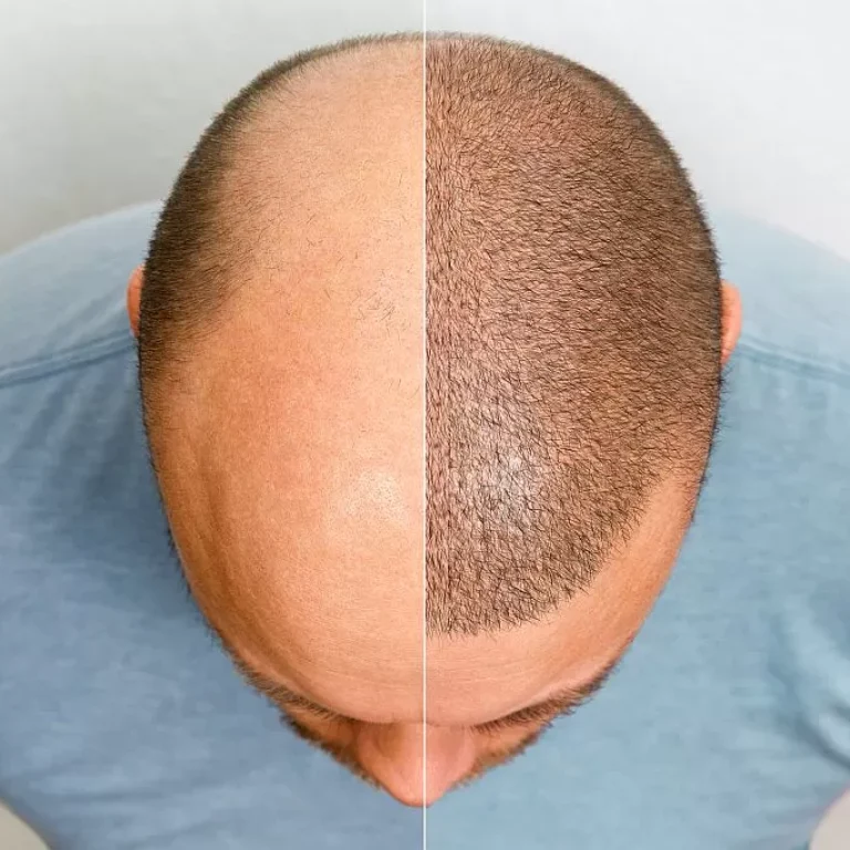 Can hair grow back after thinning male