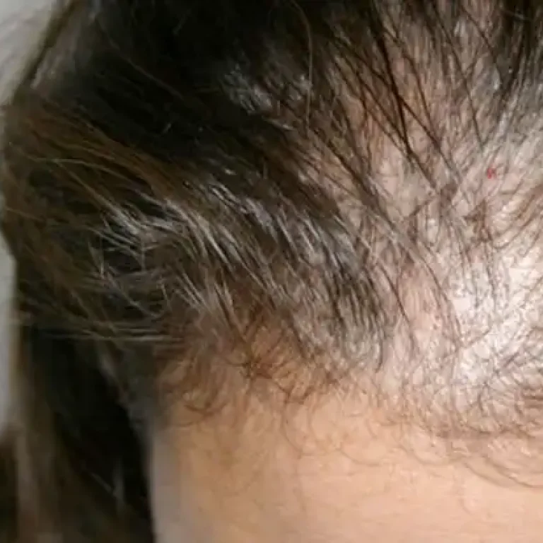 Best Alopecia Center in Islamabad