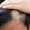 Early Frontal Fibrosing Alopecia