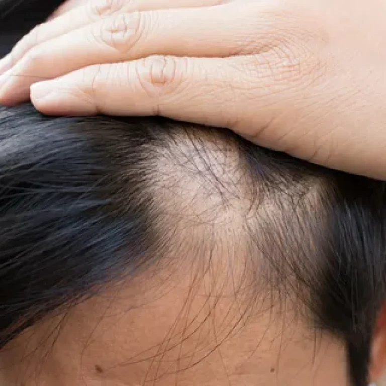 Early Frontal Fibrosing Alopecia