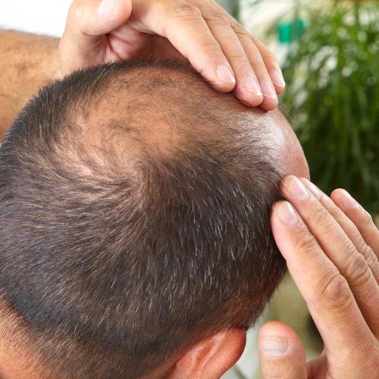 how can men regrow thinning hair