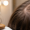 Can Sunburn on Scalp Cause Hair Loss