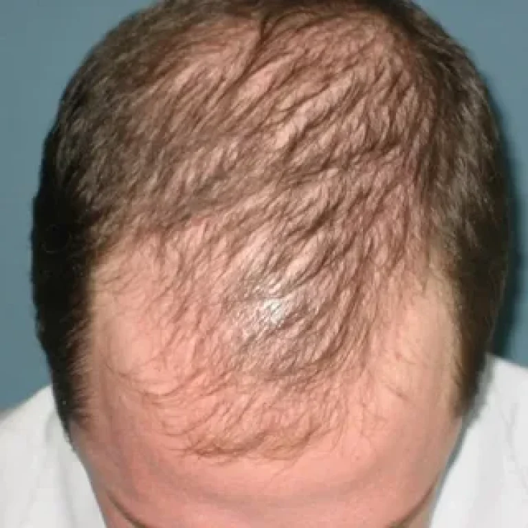 Is It Possible to Grow Back Thinning Hair